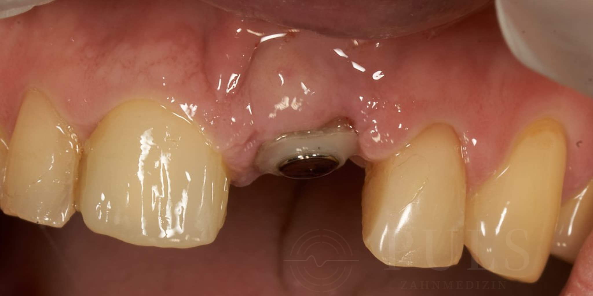 Zahnerhalt mit magnetischer Extrusion — Behandlungsaufnahme 6