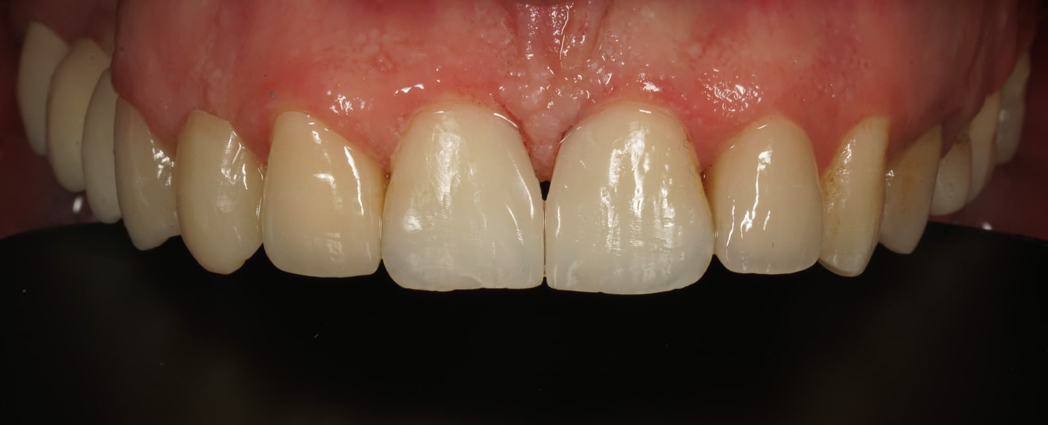 Kompozit dolgu — Ön diş diastema kapatma - Sonra