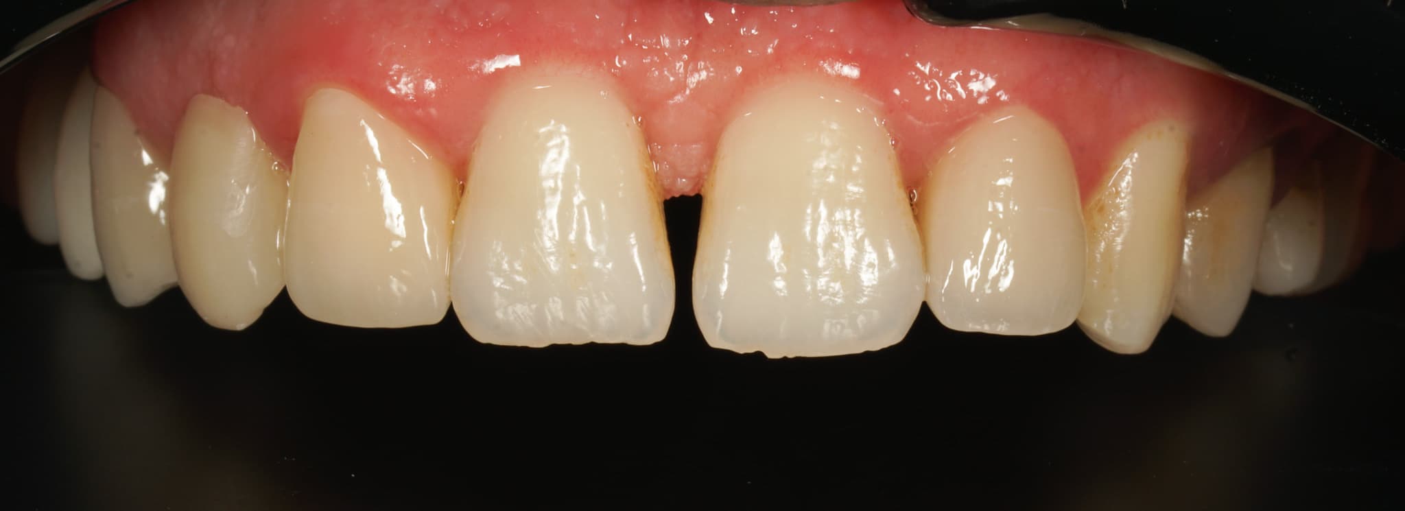 Kompozit dolgu — Ön diş diastema kapatma - Önce